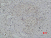 Immunohistochemical analysis of paraffin-embedded human breast caricnoma using PI 3-Kinase p85β Polyclonal Antibody.