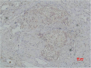 Immunohistochemical analysis of paraffin-embedded human breast caricnoma using PI 3-Kinase p85β Polyclonal Antibody.