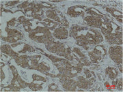 Immunohistochemical analysis of paraffin-embedded Human Breast Carcinoma using Calnexin Polyclonal Antibody.