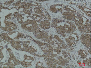 Immunohistochemical analysis of paraffin-embedded Human Breast Carcinoma using Calnexin Polyclonal Antibody.