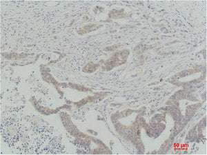 Immunohistochemical analysis of paraffin-embedded Human Colon Carcinoma using Raf-1 Polyclonal Antibody.