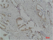 Immunohistochemical analysis of paraffin-embedded Human Breast Carcinoma using p70 S6 kinase α Polyclonal Antibody.
