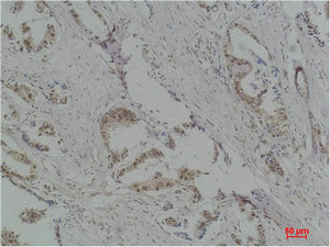 Immunohistochemical analysis of paraffin-embedded Human Breast Carcinoma using p70 S6 kinase α Polyclonal Antibody.