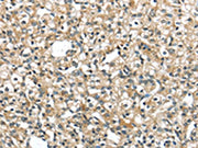The image on the left is immunohistochemistry of paraffin-embedded Human prostate cancer tissue using CSB-PA080227(SRP54 Antibody) at dilution 1/40, on the right is treated with fusion protein. (Original magnification: ×200)