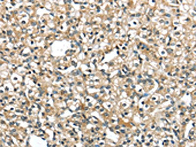 The image on the left is immunohistochemistry of paraffin-embedded Human prostate cancer tissue using CSB-PA080227(SRP54 Antibody) at dilution 1/40, on the right is treated with fusion protein. (Original magnification: ×200)