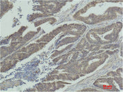 Immunohistochemical analysis of paraffin-embedded Human Colon Carcinoma using MEK-1 Polyclonal Antibody.