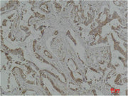 Immunohistochemical analysis of paraffin-embedded Human Breast Carcinoma using MEK-5 Polyclonal Antibody.