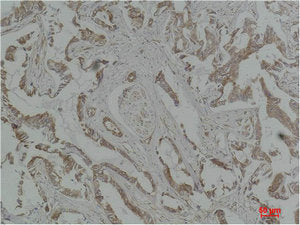 Immunohistochemical analysis of paraffin-embedded Human Breast Carcinoma using MEK-5 Polyclonal Antibody.