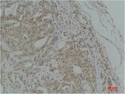 Immunohistochemical analysis of paraffin-embedded Human Breast Carcinoma using TGFβ1 Polyclonal Antibody.