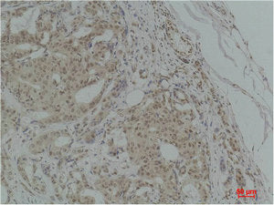 Immunohistochemical analysis of paraffin-embedded Human Breast Carcinoma using TGFβ1 Polyclonal Antibody.