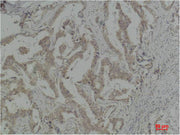Immunohistochemical analysis of paraffin-embedded Human Breast Carcinoma using Caspase-8 Polyclonal Antibody.