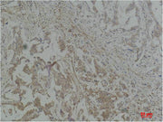 Immunohistochemical analysis of paraffin-embedded Human Breast Carcinoma using Stat1 Polyclonal Antibody.