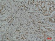 Immunohistochemical analysis of paraffin-embedded Human Breast Carcinoma using GAPDH Polyclonal Antibody.