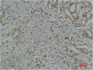 Immunohistochemical analysis of paraffin-embedded Human Breast Carcinoma using GAPDH Polyclonal Antibody.