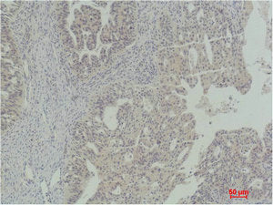 Immunohistochemical analysis of paraffin-embedded Human Ovarian Carcinoma using Stat5a Polyclonal Antibody.