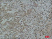 Immunohistochemical analysis of paraffin-embedded Human Breast Carcinoma using Stat3 Polyclonal Antibody.