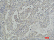 Immunohistochemical analysis of paraffin-embedded Human Lung Carcinoma using Akt2 Polyclonal Antibody.