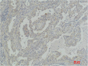 Immunohistochemical analysis of paraffin-embedded Human Lung Carcinoma using Akt2 Polyclonal Antibody.