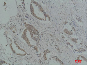 Immunohistochemical analysis of paraffin-embedded Human Breast Carcinoma using p21 Polyclonal Antibody.