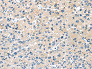 The image on the left is immunohistochemistry of paraffin-embedded Human liver cancer tissue using CSB-PA080468(HSD11B2 Antibody) at dilution 1/35, on the right is treated with synthetic peptide. (Original magnification: ×200)