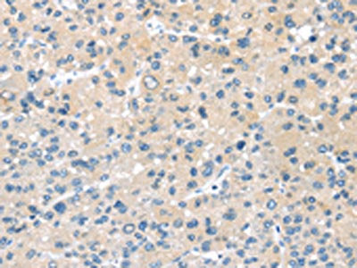 The image on the left is immunohistochemistry of paraffin-embedded Human liver cancer tissue using CSB-PA080468(HSD11B2 Antibody) at dilution 1/35, on the right is treated with synthetic peptide. (Original magnification: ×200)