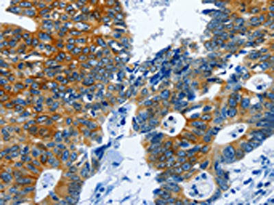 The image on the left is immunohistochemistry of paraffin-embedded Human colon cancer tissue using CSB-PA080665(BPIFB3 Antibody) at dilution 1/120, on the right is treated with synthetic peptide. (Original magnification: ×200)