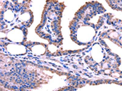 The image on the left is immunohistochemistry of paraffin-embedded Human thyroid cancer tissue using CSB-PA080676(TRIM49 Antibody) at dilution 1/40, on the right is treated with fusion protein. (Original magnification: ×200)