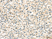 The image on the left is immunohistochemistry of paraffin-embedded Human prostate cancer tissue using CSB-PA080937(TGM4 Antibody) at dilution 1/20, on the right is treated with synthetic peptide. (Original magnification: ×200)