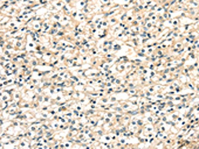 The image on the left is immunohistochemistry of paraffin-embedded Human prostate cancer tissue using CSB-PA080937(TGM4 Antibody) at dilution 1/20, on the right is treated with synthetic peptide. (Original magnification: ×200)