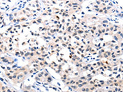 The image on the left is immunohistochemistry of paraffin-embedded Human lung cancer tissue using CSB-PA081015(IL18 Antibody) at dilution 1/120, on the right is treated with fusion protein. (Original magnification: ×200)