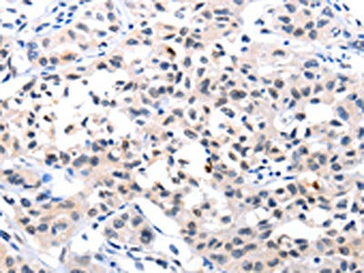 The image on the left is immunohistochemistry of paraffin-embedded Human lung cancer tissue using CSB-PA081015(IL18 Antibody) at dilution 1/120, on the right is treated with fusion protein. (Original magnification: ×200)