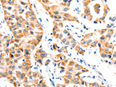 The image on the left is immunohistochemistry of paraffin-embedded Human lung cancer tissue using CSB-PA081195(PAFAH1B1 Antibody) at dilution 1/25, on the right is treated with synthetic peptide. (Original magnification: ×200)
