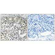 Immunohistochemistry analysis of paraffin-embedded human breast carcinoma tissue using CNTD2 antibody.
