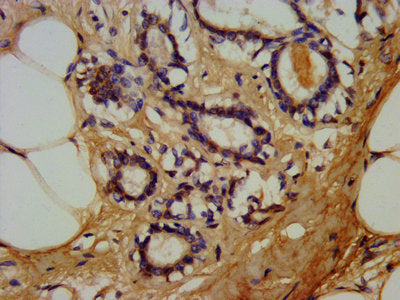 IHC image of CSB-PA08129A0Rb diluted at 1:180 and staining in paraffin-embedded human breast cancer performed on a Leica BondTM system. After dewaxing and hydration, antigen retrieval was mediated by high pressure in a citrate buffer (pH 6.0). Sec...