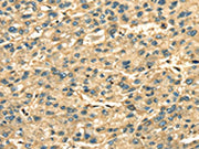 The image on the left is immunohistochemistry of paraffin-embedded Human liver cancer tissue using CSB-PA081479(ANXA2 Antibody) at dilution 1/35, on the right is treated with fusion protein. (Original magnification: ×200)