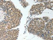 The image on the left is immunohistochemistry of paraffin-embedded Human liver cancer tissue using CSB-PA081497(ROCK2 Antibody) at dilution 1/20, on the right is treated with fusion protein. (Original magnification: ×200)