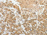 The image on the left is immunohistochemistry of paraffin-embedded Human breast cancer tissue using CSB-PA081579(TEKT1 Antibody) at dilution 1/30, on the right is treated with fusion protein. (Original magnification: ×200)