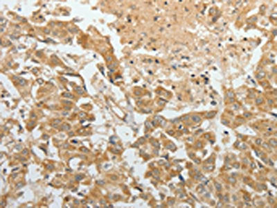 The image on the left is immunohistochemistry of paraffin-embedded Human breast cancer tissue using CSB-PA081579(TEKT1 Antibody) at dilution 1/30, on the right is treated with fusion protein. (Original magnification: ×200)