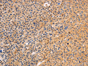 The image on the left is immunohistochemistry of paraffin-embedded Human liver cancer tissue using CSB-PA081645(SRC Antibody) at dilution 1/10, on the right is treated with fusion protein. (Original magnification: ×200)