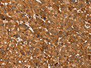 The image on the left is immunohistochemistry of paraffin-embedded Human liver cancer tissue using CSB-PA082079(TBC1D1 Antibody) at dilution 1/45, on the right is treated with synthetic peptide. (Original magnification: ×200)