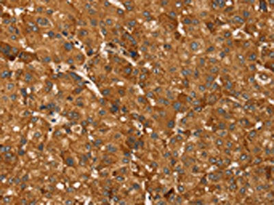 The image on the left is immunohistochemistry of paraffin-embedded Human liver cancer tissue using CSB-PA082079(TBC1D1 Antibody) at dilution 1/45, on the right is treated with synthetic peptide. (Original magnification: ×200)
