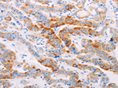The image on the left is immunohistochemistry of paraffin-embedded Human thyroid cancer tissue using CSB-PA082361(MAP4K3 Antibody) at dilution 1/30, on the right is treated with fusion protein. (Original magnification: ×200)