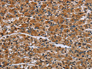 The image on the left is immunohistochemistry of paraffin-embedded Human prostate cancer tissue using CSB-PA082388(IL2RG Antibody) at dilution 1/30, on the right is treated with fusion protein. (Original magnification: ×200)