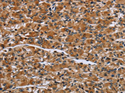The image on the left is immunohistochemistry of paraffin-embedded Human prostate cancer tissue using CSB-PA082388(IL2RG Antibody) at dilution 1/30, on the right is treated with fusion protein. (Original magnification: ×200)