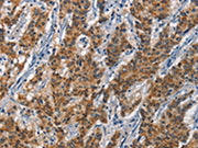 The image on the left is immunohistochemistry of paraffin-embedded Human gastic cancer tissue using CSB-PA082663(APOL1 Antibody) at dilution 1/40, on the right is treated with synthetic peptide. (Original magnification: ×200)
