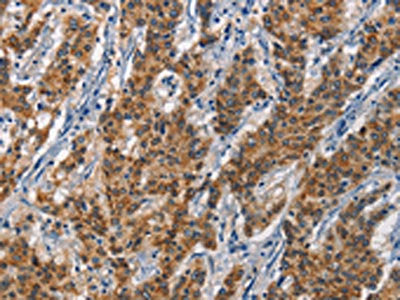The image on the left is immunohistochemistry of paraffin-embedded Human gastic cancer tissue using CSB-PA082663(APOL1 Antibody) at dilution 1/40, on the right is treated with synthetic peptide. (Original magnification: ×200)