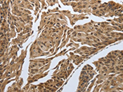 The image on the left is immunohistochemistry of paraffin-embedded Human cervical cancer tissue using CSB-PA082688(MYH11 Antibody) at dilution 1/20, on the right is treated with synthetic peptide. (Original magnification: ×200)