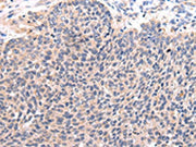 The image on the left is immunohistochemistry of paraffin-embedded Human lung cancer tissue using CSB-PA082817(CCL7 Antibody) at dilution 1/20, on the right is treated with synthetic peptide. (Original magnification: ×200)