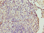Immunohistochemistry of paraffin-embedded human bladder cancer using CSB-PA08284A0Rb at dilution of 1:100