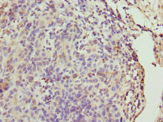 Immunohistochemistry of paraffin-embedded human bladder cancer using CSB-PA08284A0Rb at dilution of 1:100